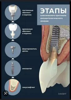 Сколько времени делать имплант
