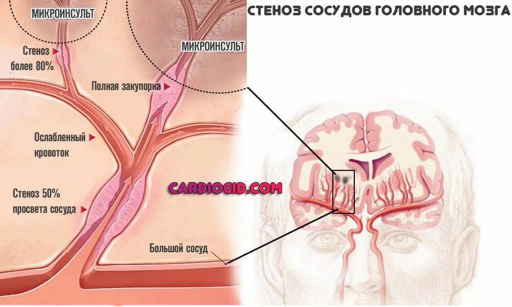 Сужение сосудов головного мозга. Сужение артерий головного мозга. Стеноз сосудов головного мозга. Стеноз артерий головного мозга.