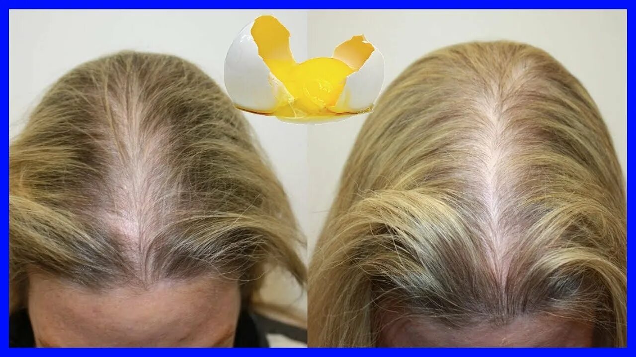 Выпадают после покраски. Мезотерапия волос до и после. Плазмолифтинг волос до и после. Алопеция у женщин до и после. Волосы алопеция до после.
