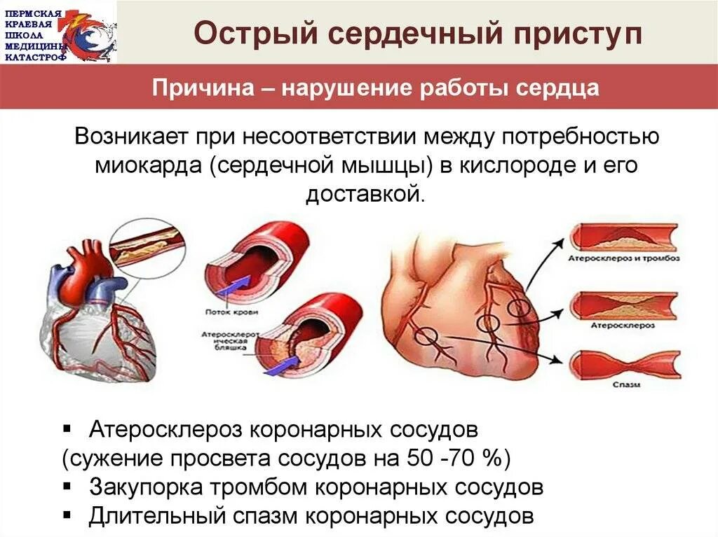 Острое сердечное нарушение. Синдром острой коронарной недостаточности. Острая коронарная сердечная недостаточность. Симптомы острой сердечной недостаточности (приступ стенокардии). ПМП при острой сердечной недостаточности.