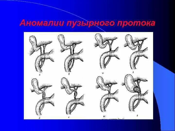Гипоплазия червя. Аномалии пузырного протока. Врожденные аномалии желчевыводящих путей. Аномалии расположения пузырного протока. Атрезия желчных протоков.
