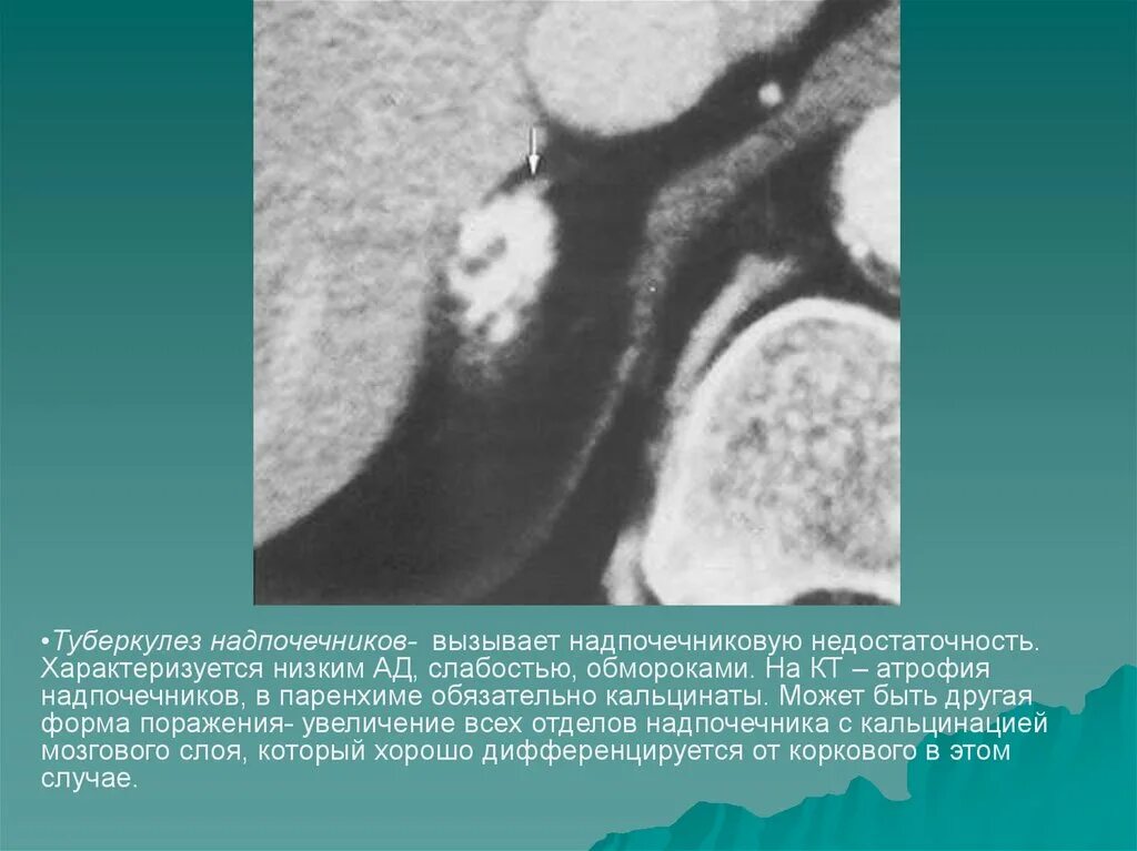Лимфоузел надпочечнике. Туберкулез надпочечников кт. Обызвествление надпочечников на кт. Кальцинат надпочечника. Кальцинаты в надпочечниках.