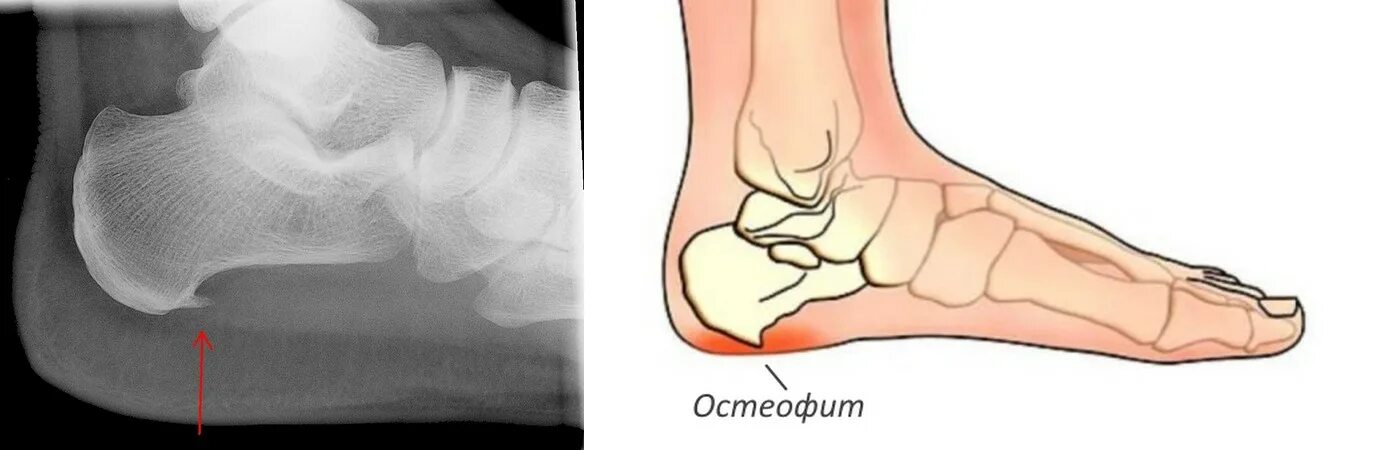 Achilles Tendonitis Consultant Mr Andrew Roche FRCS London Foot and Ankle