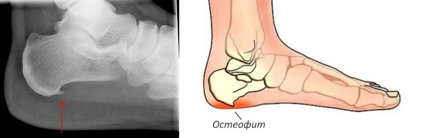Остеофиты что это такое и как лечить. Остеодина пяточных костей. Костный остеофит пяточной кости. Остеофит пяточной кости рентген.