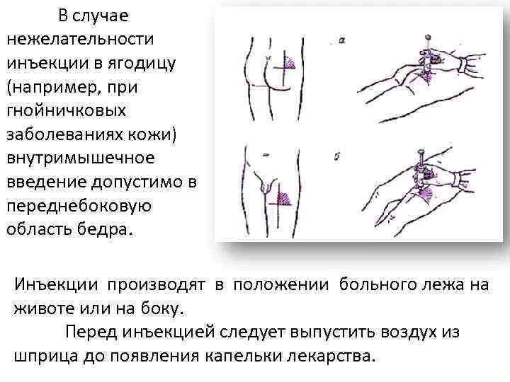 Где можно колоть. Вентро-ягодичная инъекция. Техника введения внутримышечной инъекции в бедро. Внутримышечная инъекция в бедро алгоритм. Схема введения внутримышечной инъекции в бедро.