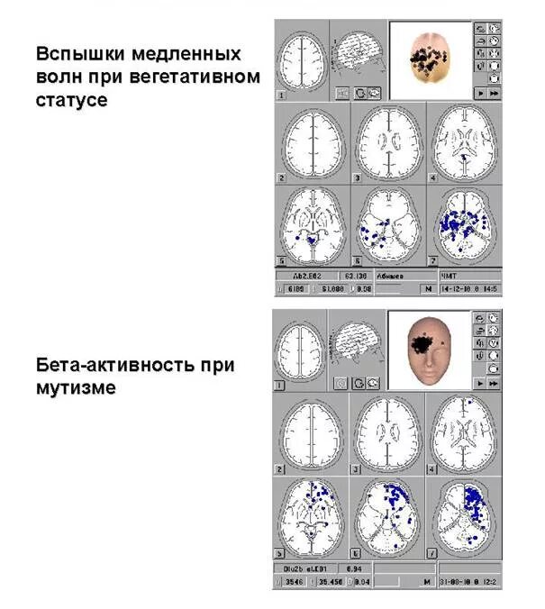 Зональные различия ээг. Ээг при когнитивных расстройствах. электроэнцефалография при чмт. гипсаритмия на ээг. изменения ээг при черепно-мозговой травме.