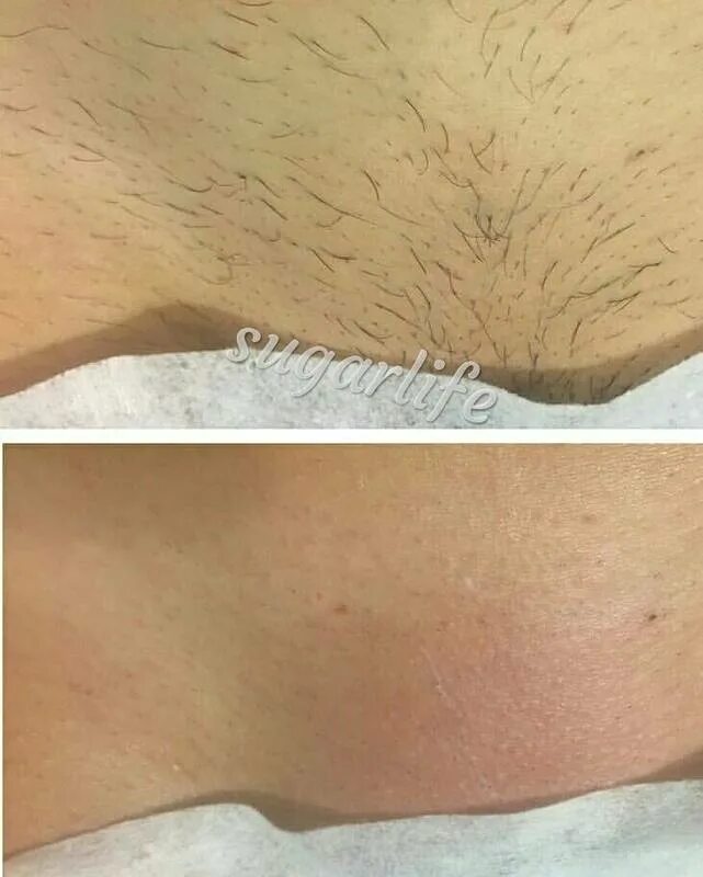 Удаление в интимных местах