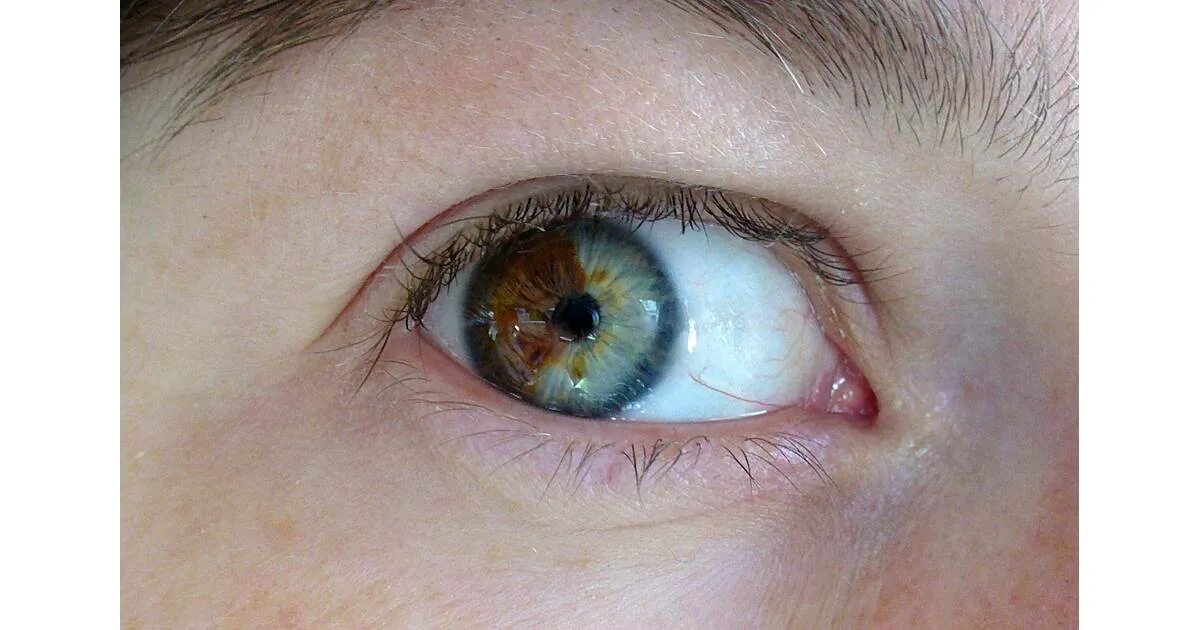 Один глаз серый другой. Гетерохромия радужной оболочки. Гетерохромный иридоциклит Фукса гетерохромия. Гетерохромия карих глаз. Зелено карие глаза гетерохромия.