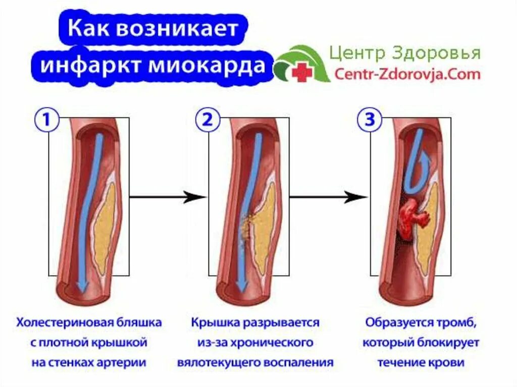 Развитие инфаркта миокарда. Бляшки инфаркт миокарда. Инфаркт перенесенный на ногах. Симптомы микроинфаркта у женщин