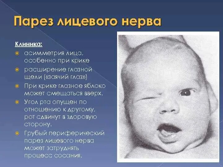 Порез лицевого. Паралич лицевого нерва у новорожденного. Родовая травма паралич лицевого нерва. Парез лицевого нерва у новорожденного.