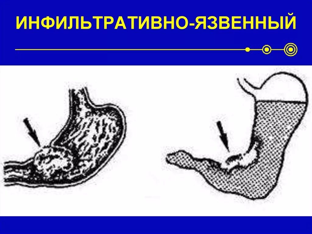 Диффузно инфильтративная. Инфильтративно-язвенная форма желудка. Инфильтративно-язвенный процесс желудка. Инфильтративная опухоль желудка. Язвенно-инфильтративная опухоль.