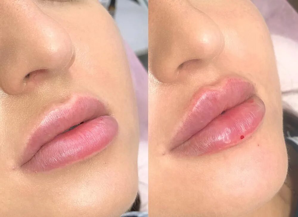 Увеличение губ lips. Увеличенные губы красивые. Красивое увеличение губ.