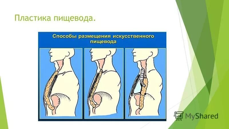 Операции на пищеводе