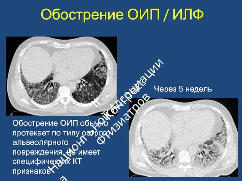 Фиброз кт. Идиопатический легочный фиброз. идиопатический легочный фиброз кт признаки. идиопатический легочный фиброз кт картина. илф кт.