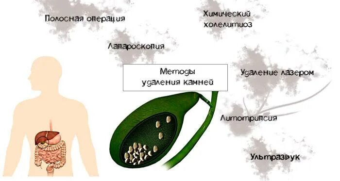 Варианты удаления камней в желчном пузыре. Операция дробление камней в желчном пузыре. Вырезанный желчный пузырь. Камни в жёлчном пузыре операция. Дробят ли камни в желчном