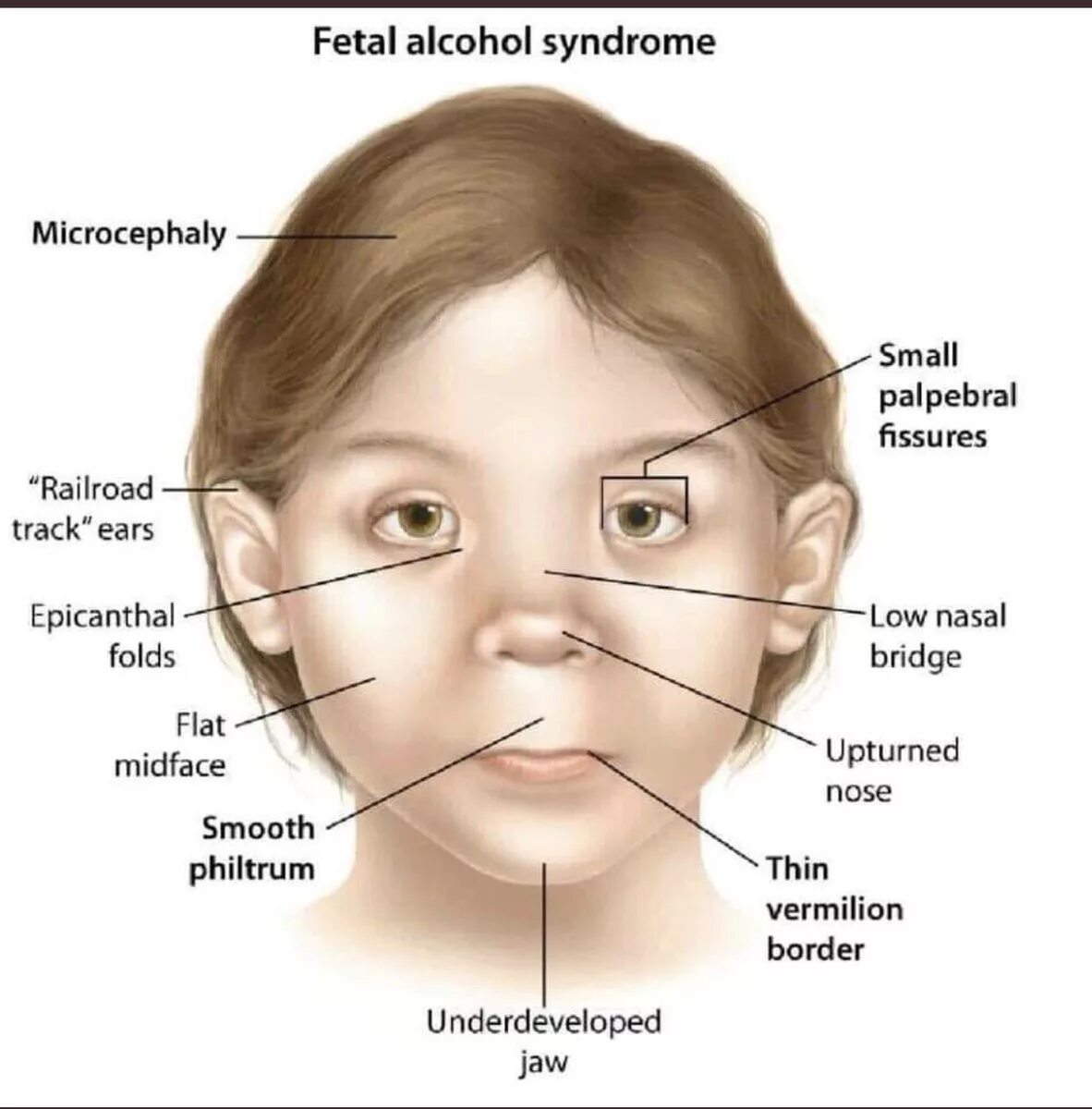 Признаки фетального алкогольного