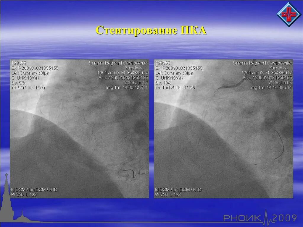 Инвалидность при стентировании. Стентирование правой коронарной артерии. УЗИ после стентирования.