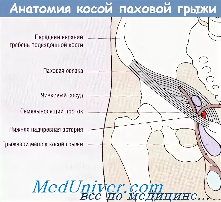 Косая и прямая паховая грыжа. Правосторонняя косая паховая грыжа. Прямая и косая паховые грыжи