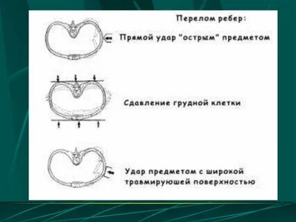 Перелом ребер описание