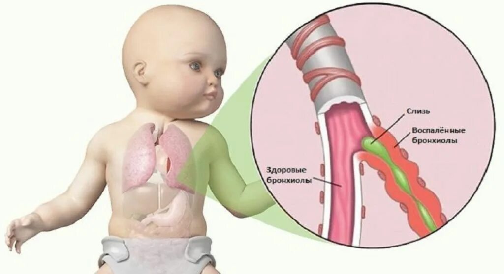 Лечение мокроты у ребенка. Аспирационный бронхит. Бронхиолит у детей пневмония.