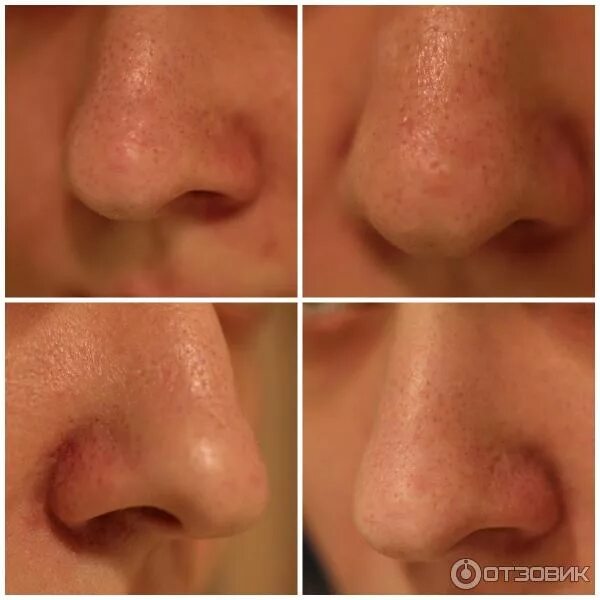 как уменьшить поры на носу