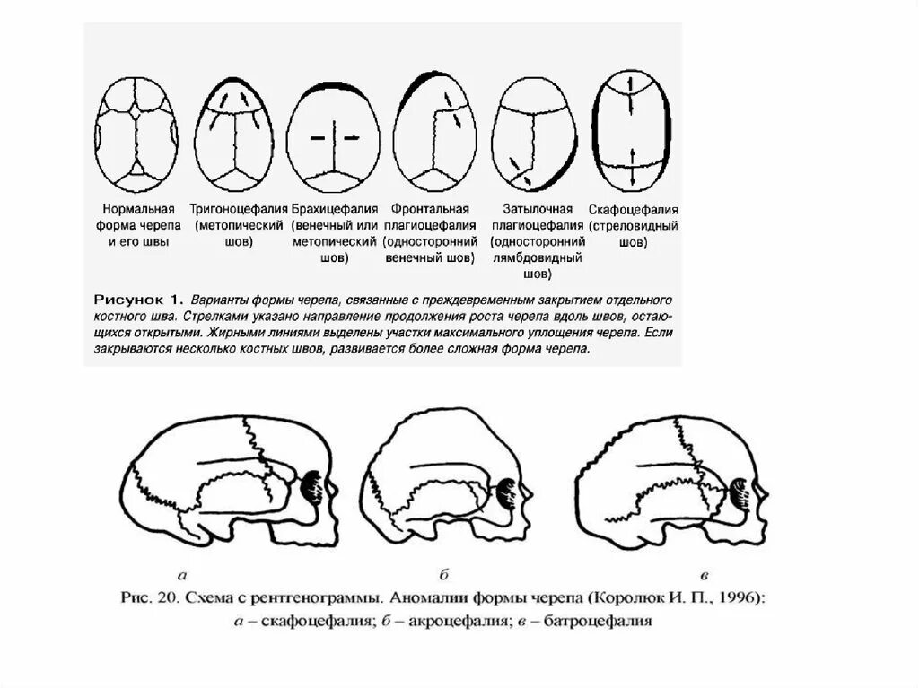 Варианты формы черепа. Формы черепа классификация. Виды черепов человека классификация. Формы черепа брахицефалия. Разновидности форм черепа.