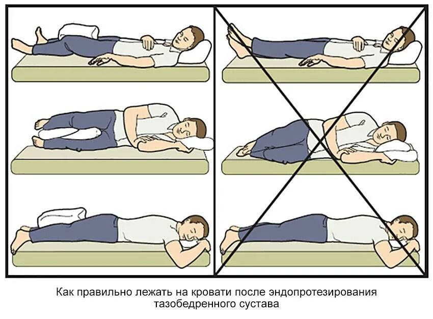 Сколько нужно полежать после. Гимнастика после эндопротезирования тазобедренного сустава. Как правильно лежать. Правильное положение для сна. Положение при сне.