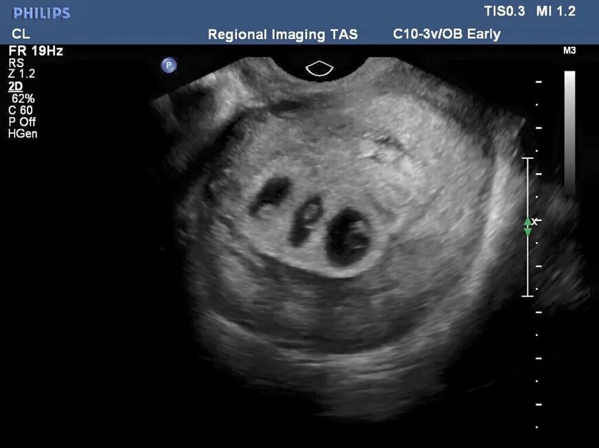 Снимок УЗИ беременности 4-5 недель двойня. Беременность тройней УЗИ 5 недель. УЗИ многоплодной беременности 5 недель фото. УЗИ на 5 неделе беременности двойня.