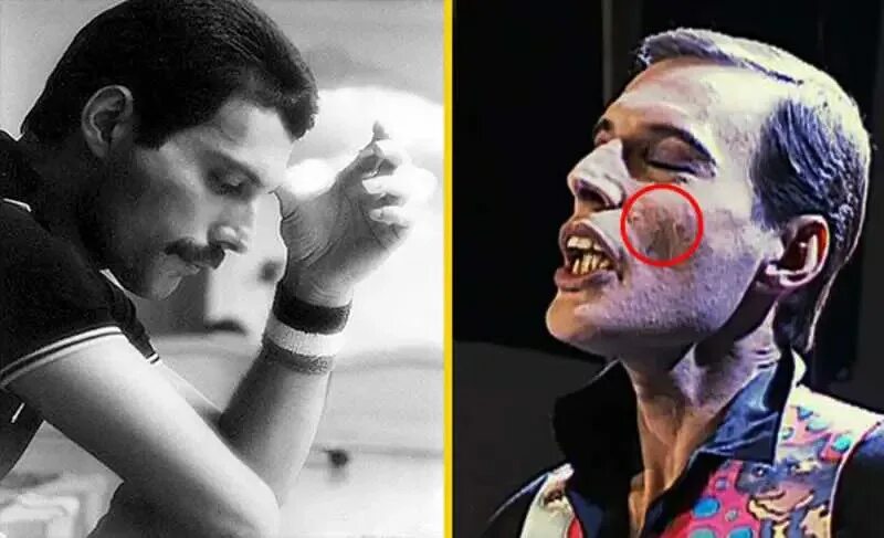 саркома капоши что это капоши у фредди меркьюри. фредди меркьюри в 1991 до смерти. Freddie mercury 1991. фредди меркури последние. умирающий фредди меркьюри.