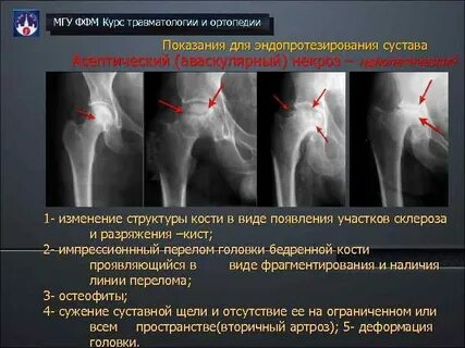 Повреждения суставов травматология