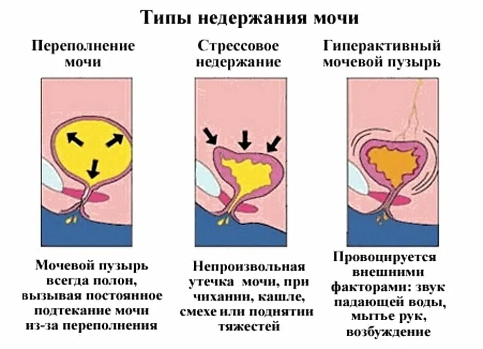 Непроизвольное Мочеиспускание У Женщин Во Время Секса