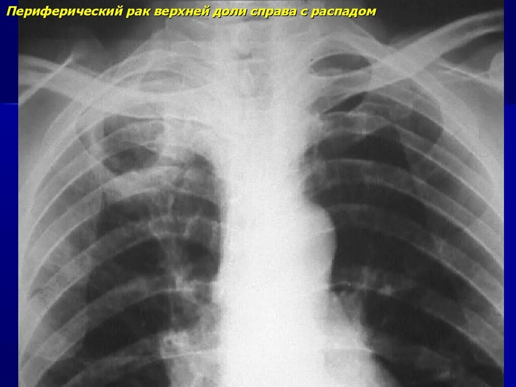 Центральный рак правого. Опухоль легкого с распадом. Снимок с распадом легкого. Опухоль с распадом на рентгене. Распад опухоли в легком.