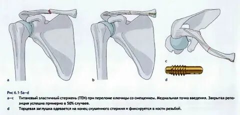 Операция на ключицы пластины