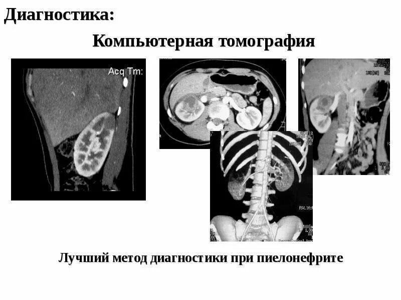 Обследование хронического пиелонефрита. Кт почек хронический пиелонефрит. Гнойный пиелонефрит на кт. Гломерулонефрит почки кт.