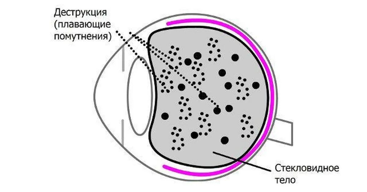 Деструкция стекловидного тела капли. Деструкция стекловидного тела черные точки. Деструкция стекловидного тела глаза. Деструкция световмдного тела. Деструкция стеклдовидноготела.