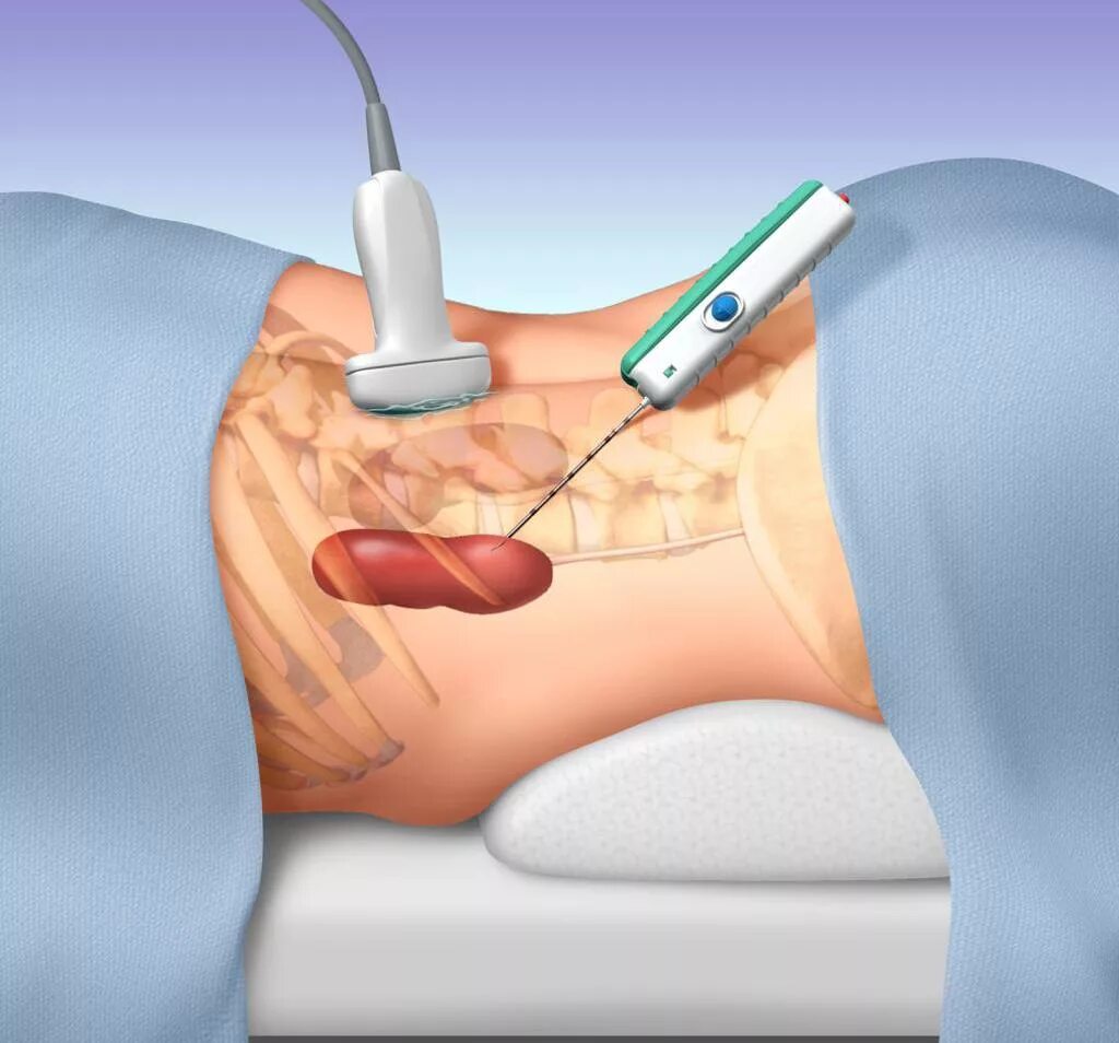 Как берут биопсию у мужчин. Чрескожная трепан биопсия печени. Тонкоигольная аспирационная биопсия печени. Трепан биопсия опухоли.