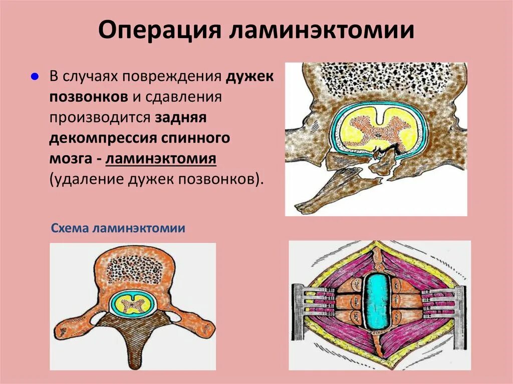 Спинной мозг ламинэктомия. Декомпрессивная ламинэктомия. Ламинэктомия шейного отдела. Ламинэктомия позвонка th5.