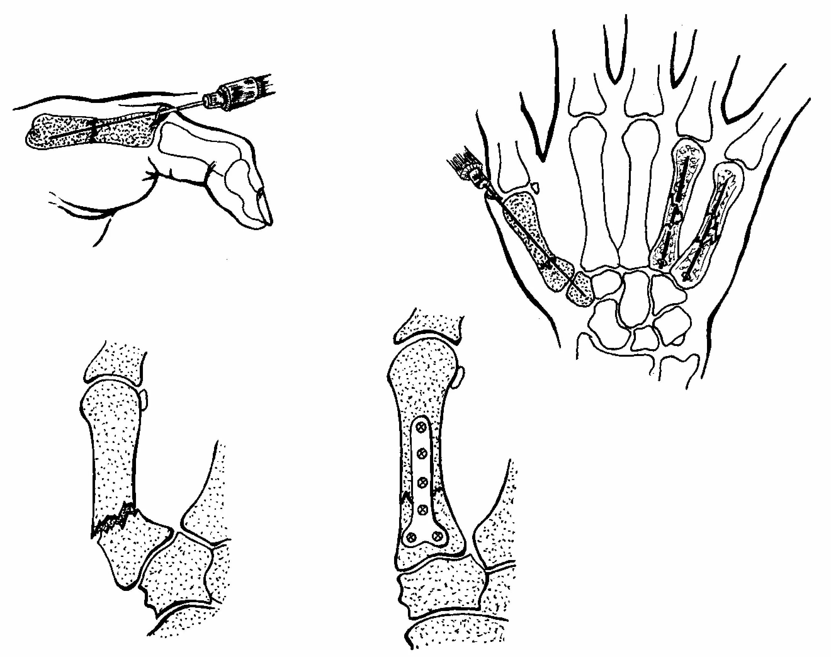 Операция пястной кости. Остеосинтез 1 пястной кости. Перелом проксимальной фаланги 1 пястной кости. Перелом Беннета 1 пястной кости. Остеосинтез 2 пястной кости.