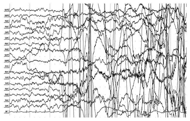 Эпи ээг. Фокальная эпилепсия на ЭЭГ. ЭЭГ показатели больного эпилепсией. ЭЭГ головного мозга эпилепсии. ЭЭГ головного мозга больного эпилепсией.
