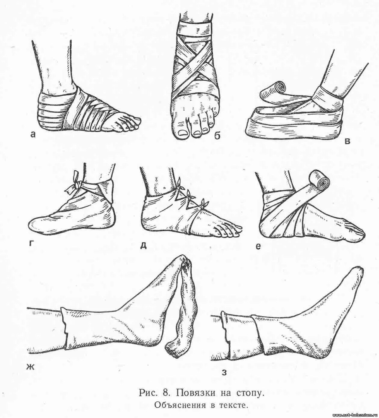 Эластичное бинтование ноги. Бинтование при растяжении голеностопа. Бинтование ноги при растяжении голеностопа. Эластичное бинтование голеностопного сустава при растяжении. Фиксация голеностопа при растяжении связок эластичным бинтом.