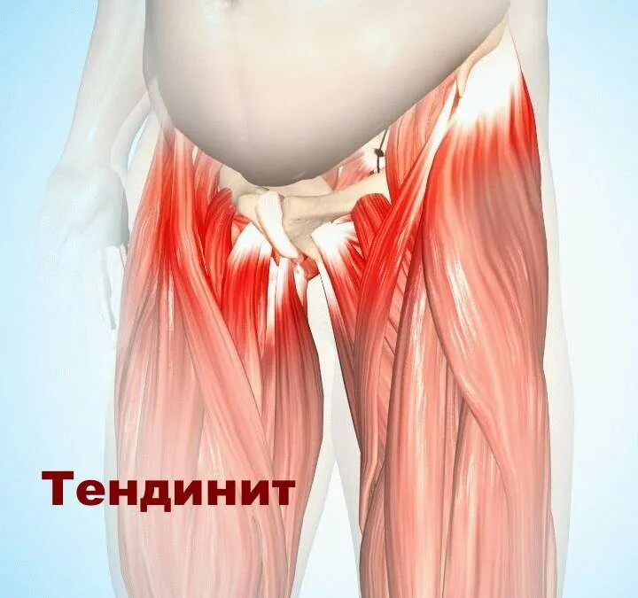 Тендинопатия сухожилий бедра. Тендинопатия сухожилия мышцы. Трохантерит тазобедренного сустава мышцы. Тендинит сухожилий ягодичных мышц.