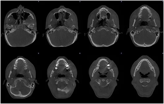 Можно ли с зубным имплантом делать мрт. Перелом верхней челюсти кт. Магнитно резонансная томография челюсти. 3д томография челюстно лицевой области. Кт 3d верхней и нижней челюсти.