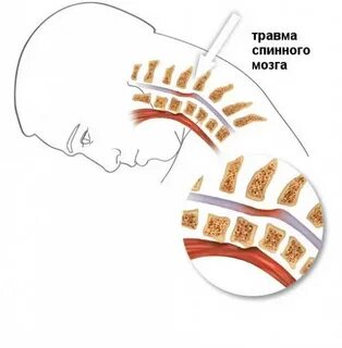 Симптомы травм спинного мозга