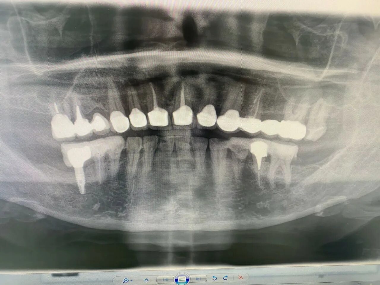 Рентген верхней семерки. Зуб 7 верхний скошен.