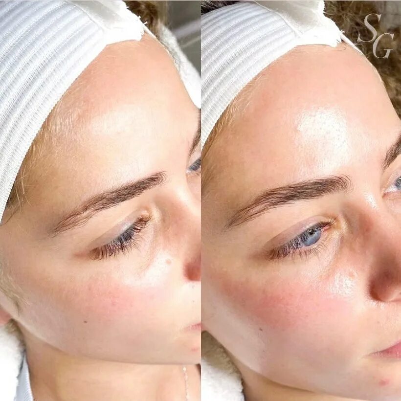 Чистка лица у косметолога подростку. Комбинированная чистка лица пилинг. Пилинг лица у косметолога. Подростковая косметология. Чистка лица у подростков у косметолога.