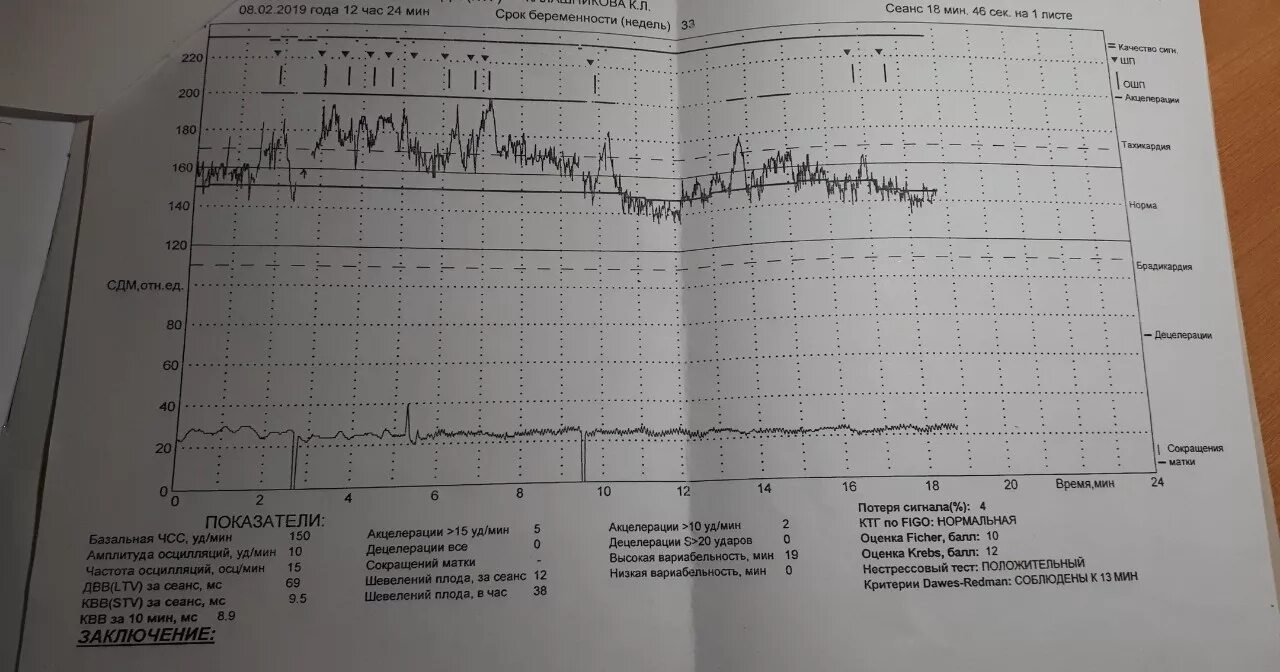 Сердцебиение 14 недель. КТГ тахикардия плода 36 неделе беременности. Тахикардия на КТГ У плода. КТГ при тахикардия у плода. Учащенное сердцебиение плода на КТГ.