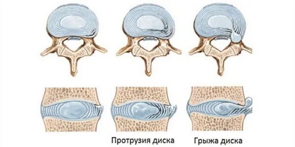 Фиброзное кольцо межпозвоночного диска. Разрыв фиброзного кольца межпозвоночного. Трещина фиброзного кольца. Фиброзное кольцо позвоночника грыжа. Разрыв пульпозного ядра межпозвоночного диска.