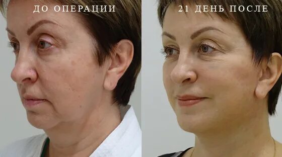 Кахраманов пластический хирург. Кахраманов беглар умбатович. кахраманов беглар умбатович блефаропластика. беглар умбатович кахраманов клиника. фибробласты в пластической хирургии.