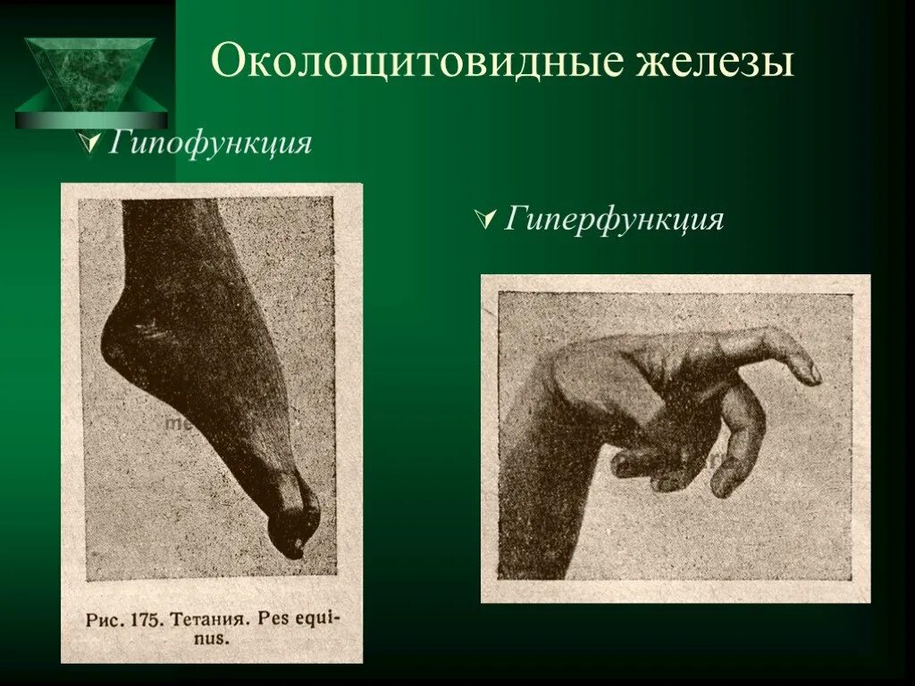 Гипофункция паращитовидных желез вызывает. Паращитовидные железы гормоны гипер гипо функции. гиперфункция паращитовидных желёз. околощитовидные железы гормоны гиперфункция и гипофункция. паращитовидная железа гормоны гиперфункция.