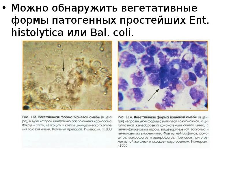 Грибы в копрограмме у взрослого. Стеаторея микроскопия кала. Атлас копрограмма микроскопия. Микроскопия кала макрофаги.